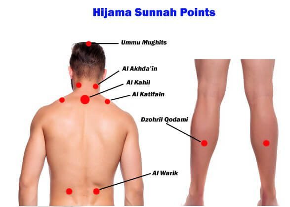 hijama sunnah points on body