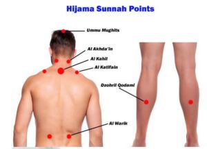 Read more about the article Hijama Sunnah Points on Body