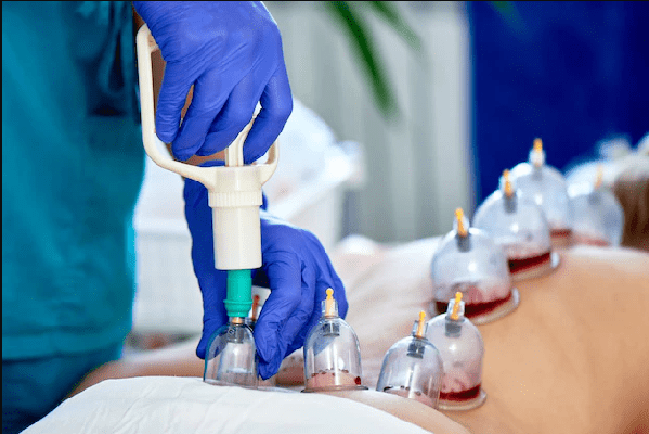 You are currently viewing <strong>How Cupping (hijama) Works</strong>
